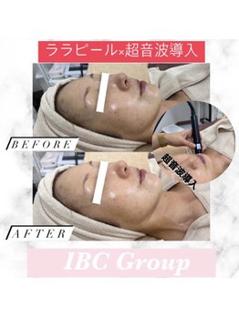 IBC 上大岡店/ララピール×超音波導入