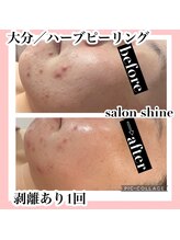 サロンシャイン(Salon Shine)/２０代後半女性ハーブ１回