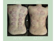 京 鍼灸院 整体院/一回目と三回目のカッピング痕