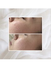 プリマプリート 名駅店/プラズマ光フェイシャル