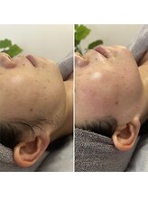 トリプルワン(111)/艶感UPフェイシャルワックス脱毛