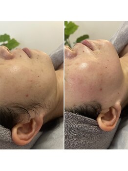 トリプルワン(111)/艶感UPフェイシャルワックス脱毛