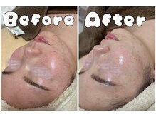 グラシア 倉敷店(Gracia)/ハーブピーリング＋毛穴洗浄