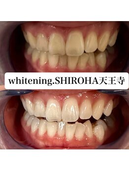 シロハ(SHIROHA)/セルフホワイトニング/天王寺