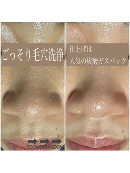 エステルーム クリスタル/ごっそり毛穴洗浄+炭酸パック