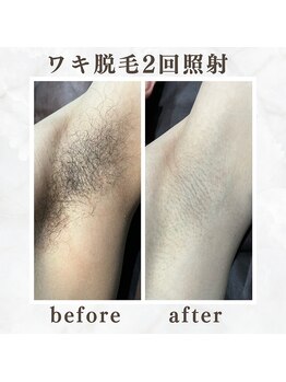 ボゴス(BOGOSS)/【脇脱毛】施術写真