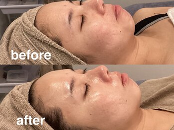 ヴィセラ(Vicella)/ニキビの凹凸に!