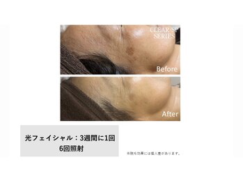 サロン ルアナ(salon luana)/光フェイシャル　before→after
