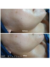 ベルクラージュ(Belle Courage)/20代　リフトアップ