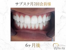 ホワイヤ セルフホワイトニング DBS神楽坂(Whi-Ya)/☆サブスク会員様☆納得の白さ☆