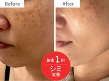 アクア(akua....)/施術1回★シミの改善