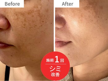 アクア(akua....)/施術1回★シミの改善