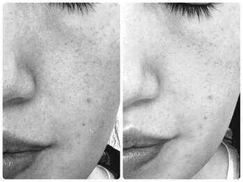 アール(R)/【プラズマシャワー】