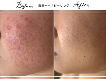 アリュール 倉敷(ALLURE)の写真/【人気No.1の肌質改善メニュー】肌に優しい濃厚ハーブで素肌の内側から改善◎化粧ノリ＆浸透率も抜群♪