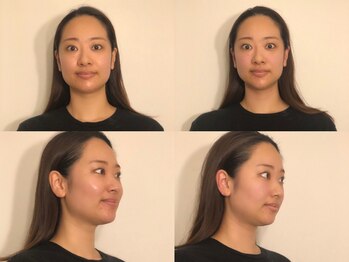 フラット(FURATTO)/Before - After【施術回数1回】