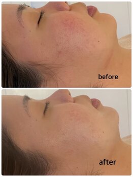 マーキュリー(Mercury)/ハーブピーリングのお客様