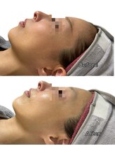 オルオル 天神大名店(Olu-.olu.)/肌質改善しみ改善/小顔/ツヤ肌