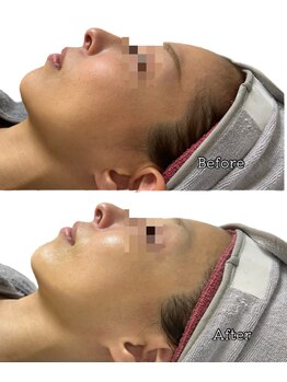 オルオル 天神大名店(Olu-.olu.)/肌質改善しみ改善/小顔/ツヤ肌