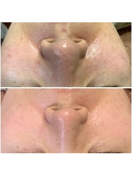 サロンメロウ 大牟田店(salon mellow)/肌質改善/ハーブピーリング 