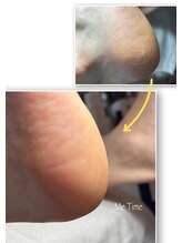 ミータイム(Me Time)/FOOT角質ケア