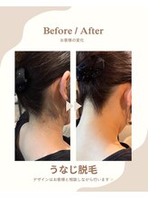 ラナンス 千早(LANUNCE)/うなじ脱毛