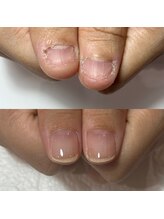 セラキュアネイル(Theracure nail)/深爪のお悩みも解消