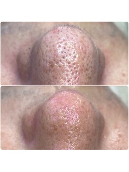 プアラ(puala)/ビフォーアフター