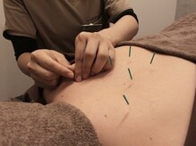 ラクセイ(RAKUSEI)/【鍼（はり）施術】