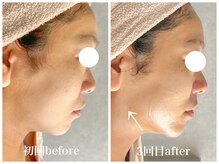 ルー ハナレ 神戸岡本 摂津本山店(Luu HANARE)/フェイスライン　肌質改善