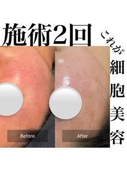 サロンツキ(salon tuki)/ハーブピーリング症例/徳島