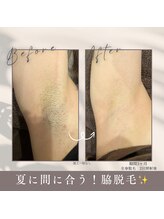 モアトゥインクル 山口店(MORE twinkle)/★症例写真★【20代】