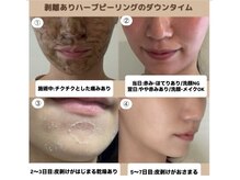 ハル(Halu)の雰囲気（ハーブピーリング・ダウンタイムはスケジュール調整が必要です。）