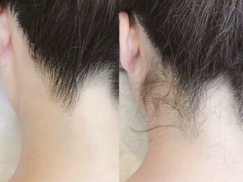 サロンドラッジ(Salon de Raggi)/【脱毛】うなじ