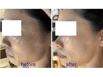 ビオール 池袋店(beall)/全顔丸ごとフェイシャルコース