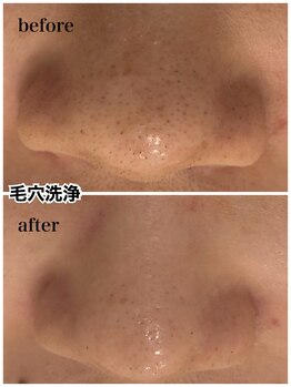 アール(R)/【 毛穴洗浄ビフォーアフター 】