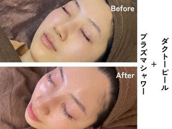 ギルドハナレ(GUILD HANARE)/"毛穴×くすみ"