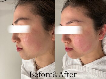 トウキョウビューティーラボ(TOKYO BEAUTY LABO.)/小顔マッサージBefore&Afer