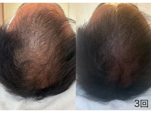 幹細胞を使った育毛促進ケア☆本来の細胞を元気に健康に！！