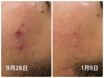 デューン 蕨店(Dune)/ニキビ