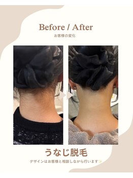 ラナンス 千早(LANUNCE)/うなじ脱毛