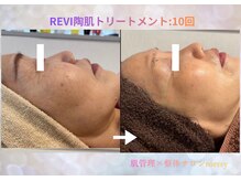 メリー 大和西大寺店(merry)/ハーブピーリングBefore after★