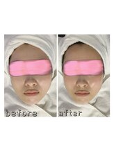 エクスクラメーションマーク(!!!)/超音波リフトアップ