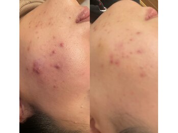 長寿鍼灸院 長寿整骨院/肌荒れに効果的美容鍼の効果★