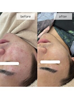 ヴィーナス(Venus)/韓国ダーマエステ　6回