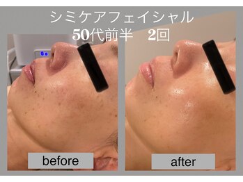 ブリノス(BLINOSS)/シミケアフェイシャル