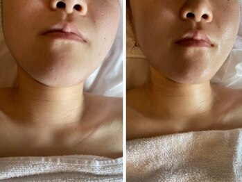 リジュ(Reju)/1度の施術で実感！小顔