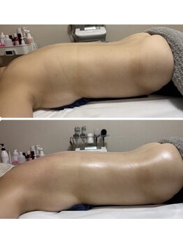 リュミエール(umiere)/1回で変わるボディライン☆