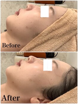 スペチアーレ 夙川/横顔を更に美しく