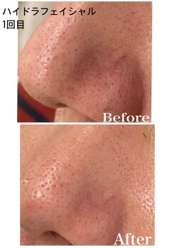 アカヌケ(AKANUKE)/ニキビケアに毛穴洗浄がおすすめ