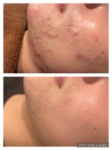 ラパス(Lapaz)/こじらせニキビケア